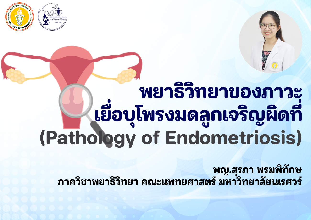 พยาธิวิทยาของภาวะเยื่อบุโพรงมดลูกเจริญผิดที่ (Pathology of Endometriosis)