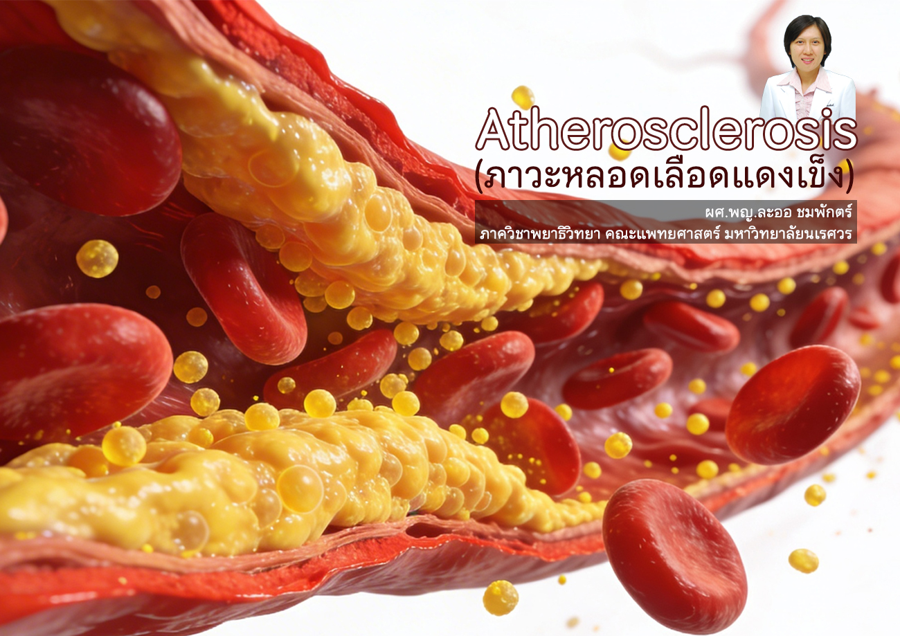 Atherosclerosis (ภาวะหลอดเลือดแดงแข็ง)